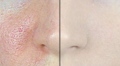 عوارض لیزر روی پوست را جدی بگیرید